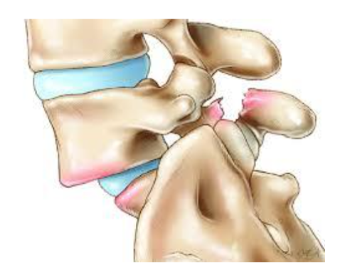 Distorted Lower Back Lower Back Pain | Sunshine Coast Rehab & EP
